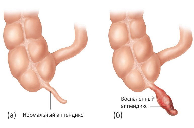 Симптомы аппендицита + 16 лучших методов восстановления