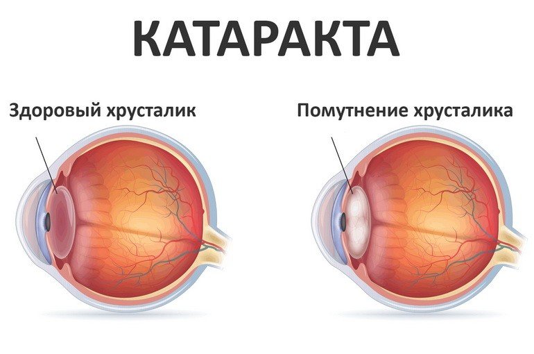 Катаракта: что это такое, причины, симптомы, лечение и профилактика