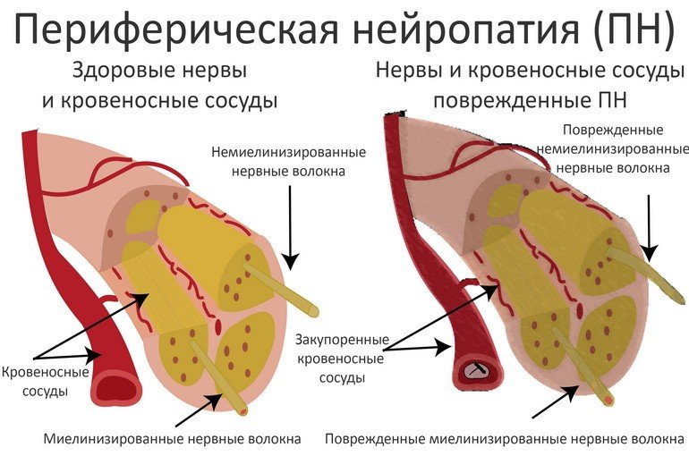 Периферическая нейропатия: симптомы, причины, лечение